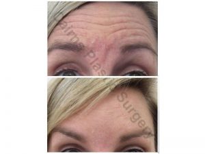 Anti-wrinkle-Injection_0001_2