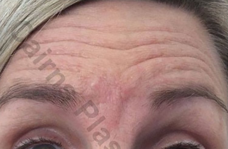 anti wrinkle injections before