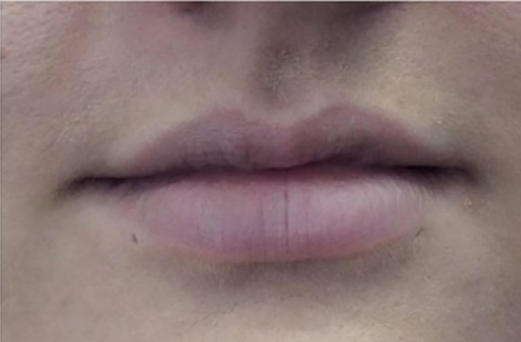 lip dermal fillers before
