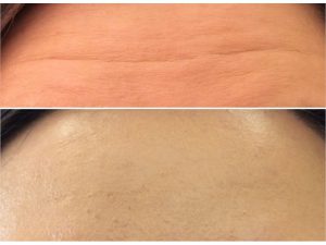 Dermal-Fillers_0006_7