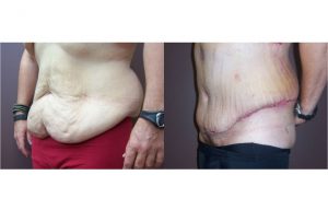 Gynecomastia_0004_5