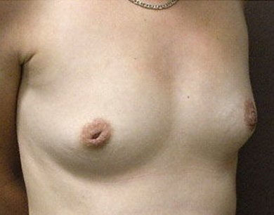 Breast Augmentation Cairns before photos