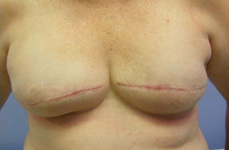 Mastopexy Breast Reconstruction After