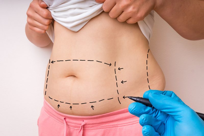Plastic surgery doctor draw lines with black marker on patient belly