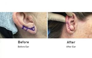 Skin Cancer: Ear before and after surgery