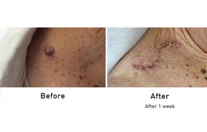 Skin Cancer before and after 1 week surgery