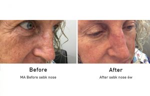Skin Cancer: SEBK Nose before and after 6 week surgery