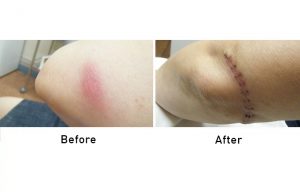 Skin Cancer before and after surgery